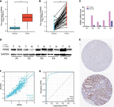 Over-expression of RRM2 predicts adverse prognosis correlated with immune infiltrates: A potential biomarker for hepatocellular carcinoma